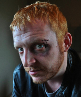 ryan-black-eye